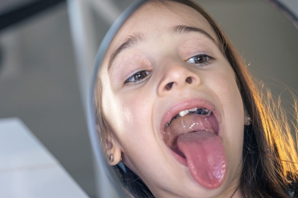 When Do Children Need a Palatal Expander? Signs, Timing and Expected Results image